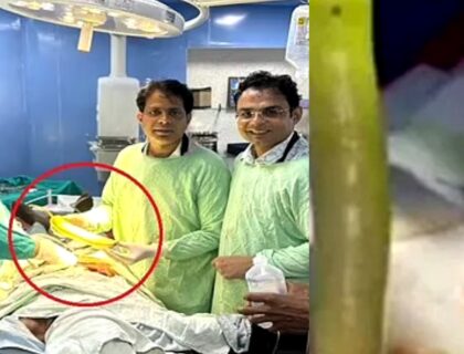 Doctors Remove 18-Inch Long Vegetable From Farmer’s Backside After He Complained Of Stomach Pain