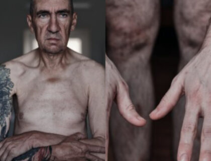 Before and After Photos Show Drastic Weight Loss in Ukrainian War Prisoners After Two Years in Russian Captivity