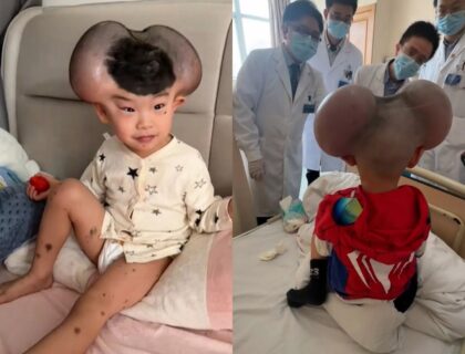 Boy Undergoes Remarkable Transformation After Rare Condition Earned Him ‘Mickey Mouse’ Nickname
