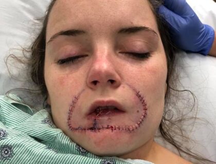 Woman Whose Lip Was Severed by Ex-Boyfriend Shares Recovery Seven Years Later