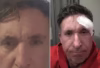 Robbie Fowler Undergoes Surgery To Remove Skin Cancer From Face