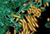 Ebola Surge Claims 65 Lives in Eastern DR Congo